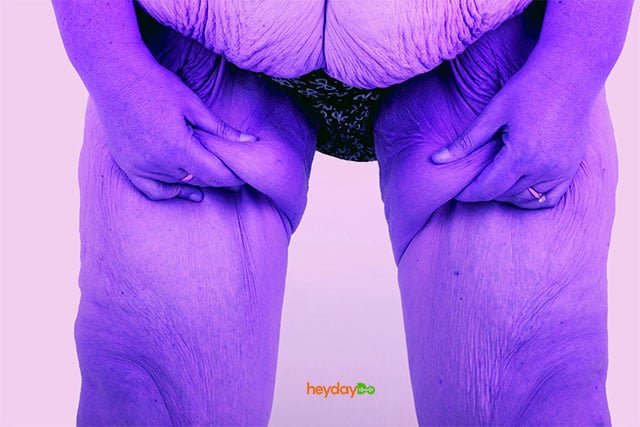 Weight Loss Loose Skin Myth - heydayDo - featured image